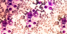 Microscopic cells slide with purple and white spots, indicating cancerous multiple myeloma cells.